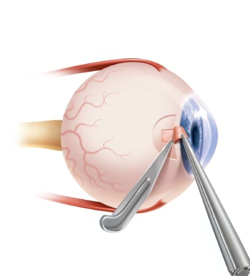 Advanced Retina Care