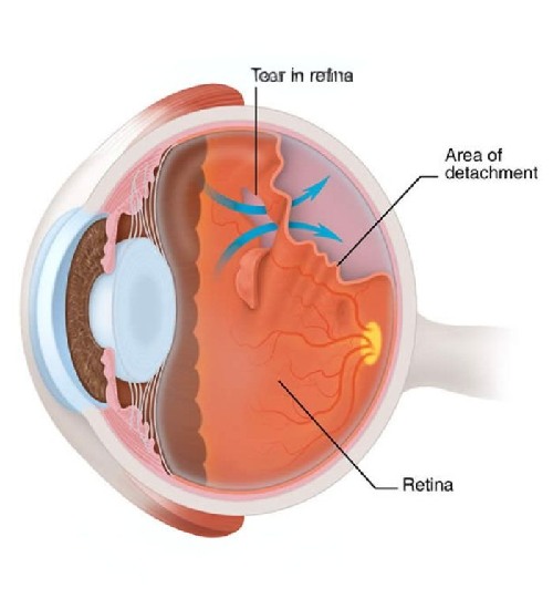Advanced Glaucoma Surgery