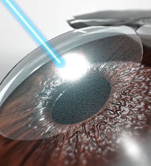 Lasik(Laser-Assisted In Situ Keratomileusis)