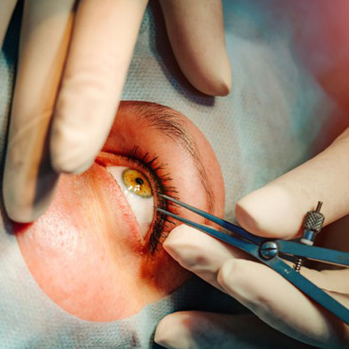 Oculoplasty